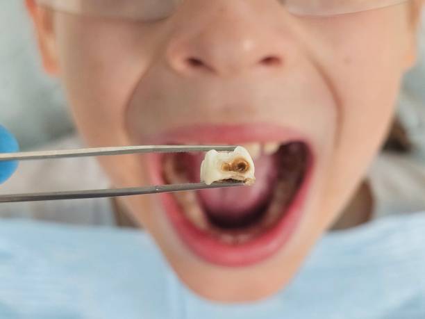 Best Broken or Chipped Tooth Repair in Perryton, TX